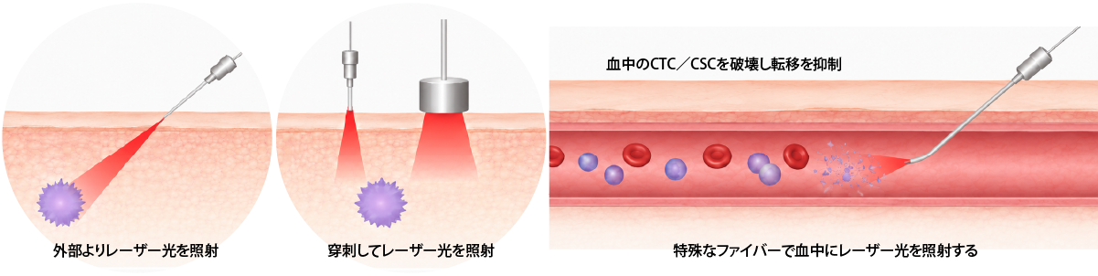 青木優美クリニックの光免疫治療の治療について