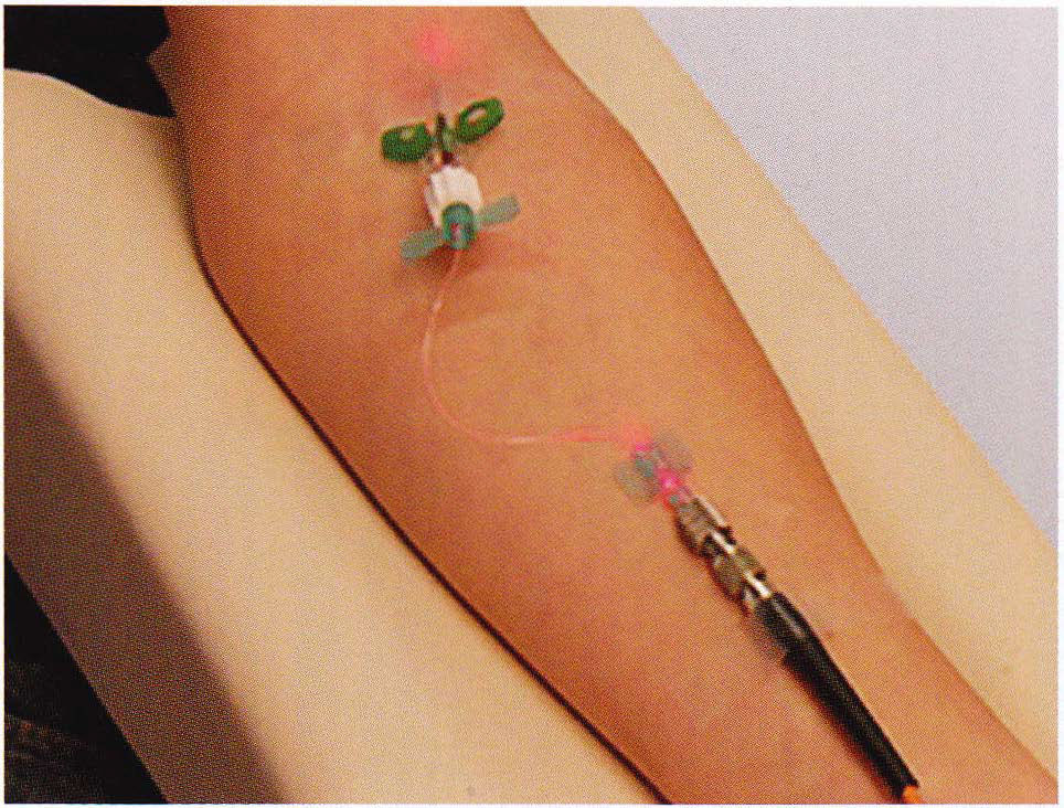 青木優美クリニックの光免疫治療の使用例静脈内レーザー治療